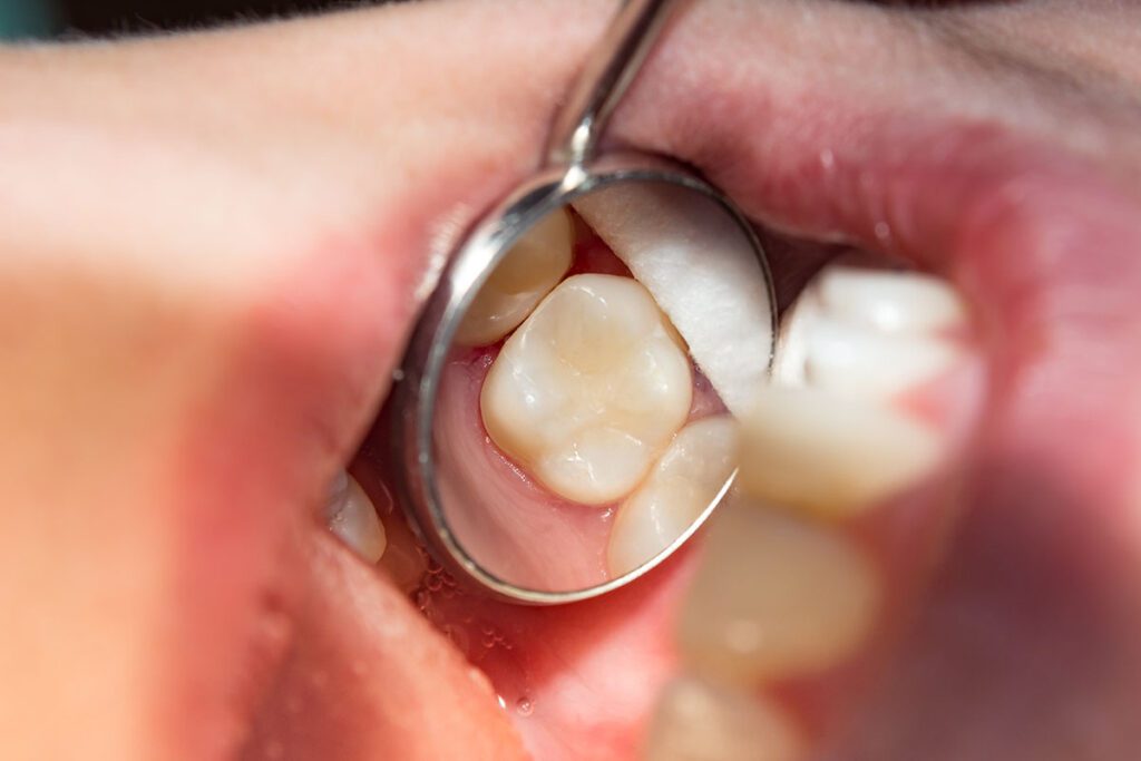 dental fillings in Chula Vista