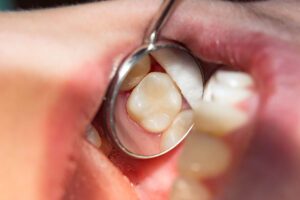 dental fillings in Chula Vista